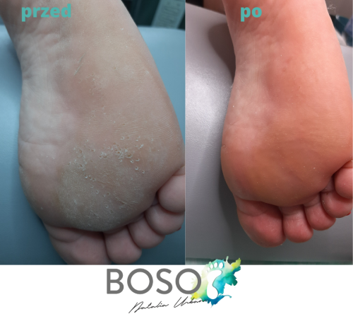 galeria-1-natalia-urban-podolog-swidnica-boso