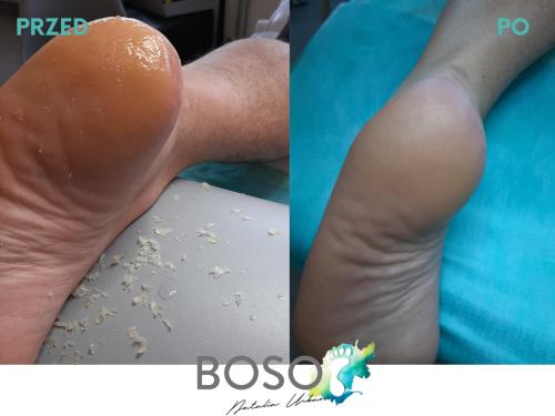 galeria-2-natalia-urban-podolog-swidnica-boso