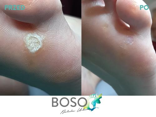 galeria-6-natalia-urban-podolog-swidnica-boso